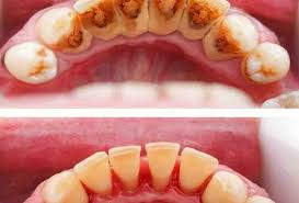 What is a dental bridge?